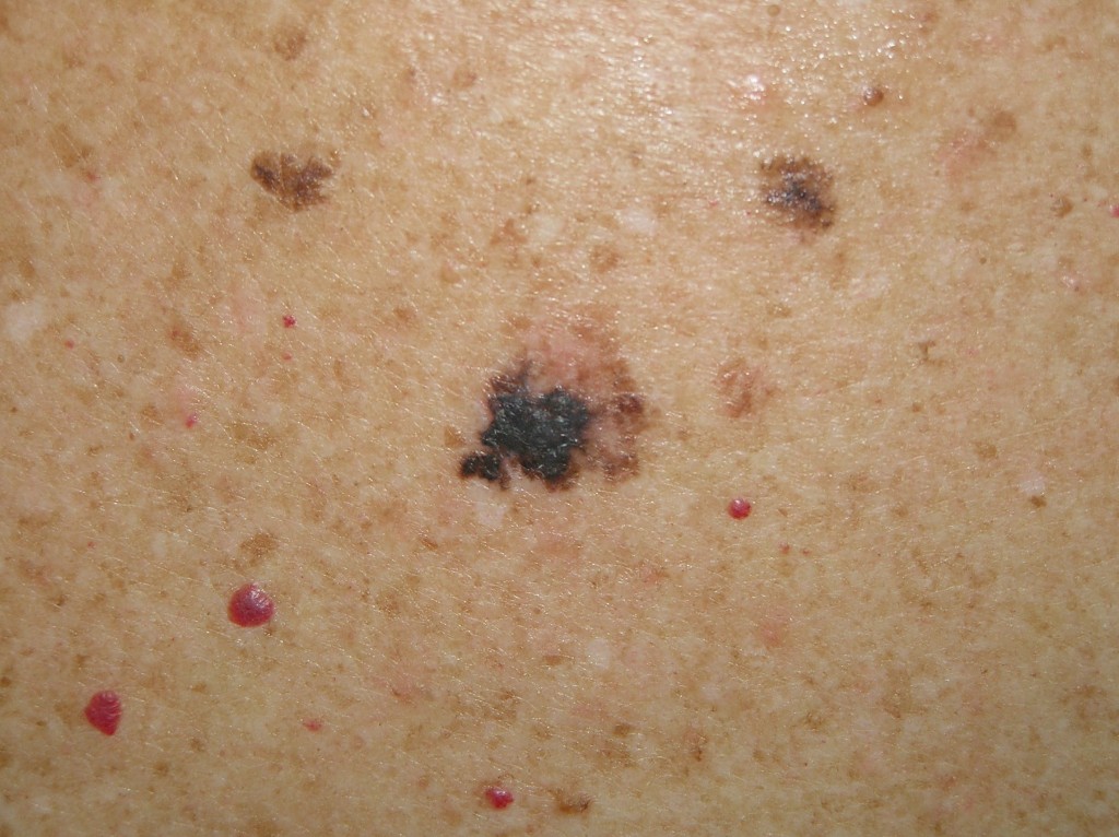 Melanoma Imagen de melanoma