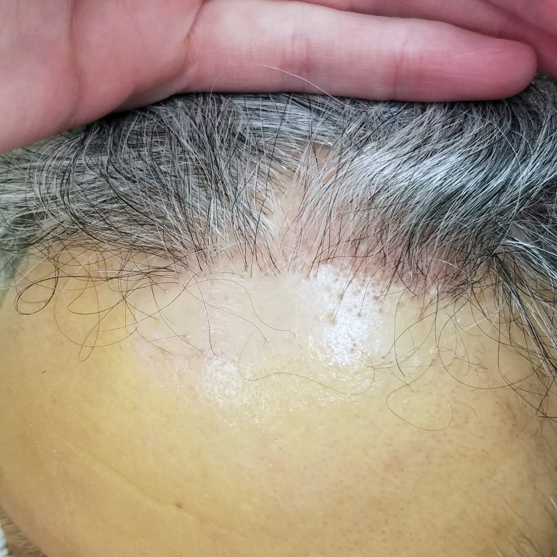 Alopecia Frontal
